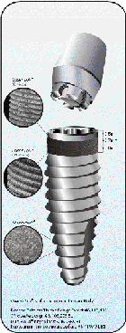 laser-lok implant